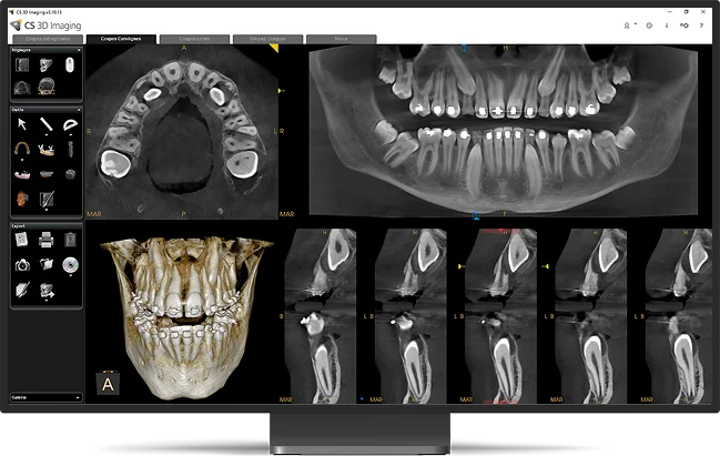 CS 3D Imaging CBCT scan software at WhiteZone Dental
