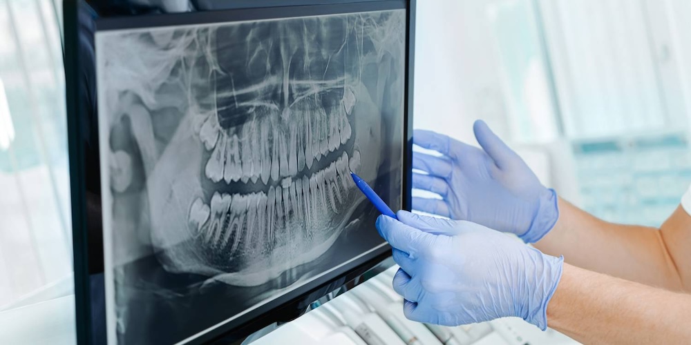 Dentist reviewing a low-dose digital X-ray at WhiteZone Dental